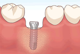 インプラントの植え込み
